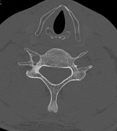 Clay-shoveler fracture (Radiopaedia 14604-14532 Axial bone window 2).jpg