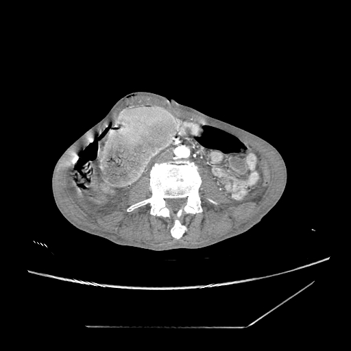 Closed-loop obstruction due to peritoneal seeding mimicking internal hernia after total gastrectomy (Radiopaedia 81897-95864 A 114).jpg