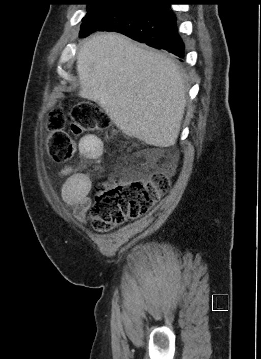 Closed loop obstruction - internal hernia into nephrectomy bed (Radiopaedia 59867-67320 C 94).jpg