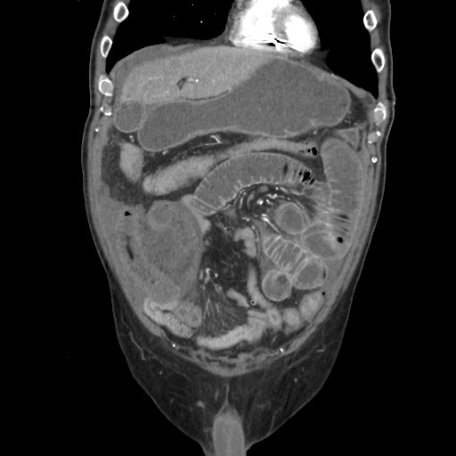 File:Closed loop obstruction due to adhesive band, resulting in small bowel ischemia and resection (Radiopaedia 83835-99023 C 38).jpg