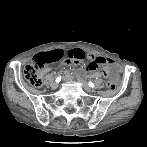 Closed loop small bowel obstruction - adhesions and infarct (Radiopaedia 85125-100678 A 130).jpg