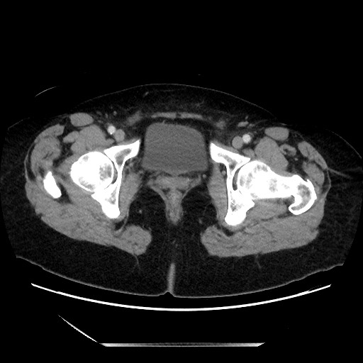 Closed loop small bowel obstruction due to adhesive bands - early and late images (Radiopaedia 83830-99014 A 152).jpg