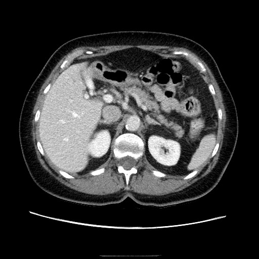 Closed loop small bowel obstruction due to adhesive bands - early and late images (Radiopaedia 83830-99015 A 44).jpg