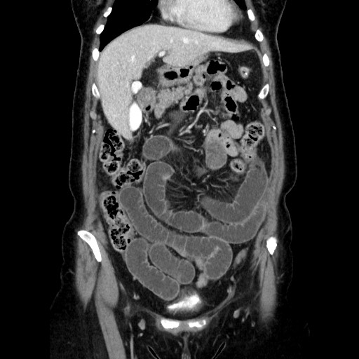 File:Closed loop small bowel obstruction due to adhesive bands - early and late images (Radiopaedia 83830-99015 B 42).jpg