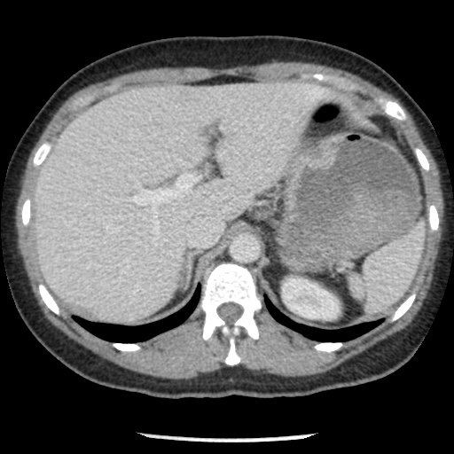 Closed loop small bowel obstruction due to trans-omental herniation (Radiopaedia 35593-37109 A 25).jpg