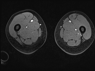Closed loop small bowel obstruction in pregnancy (MRI) (Radiopaedia 87637-104031 G 65).jpg