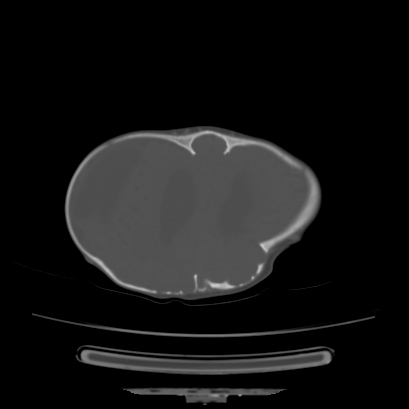 Cloverleaf skull (Radiopaedia 91901-109710 Axial bone window 115).jpg