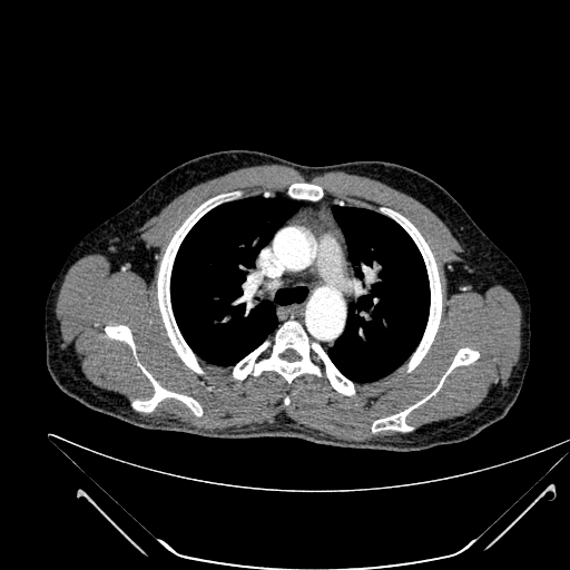 File:Coarctation of the aorta (Radiopaedia 49784-55050 B 70).jpg