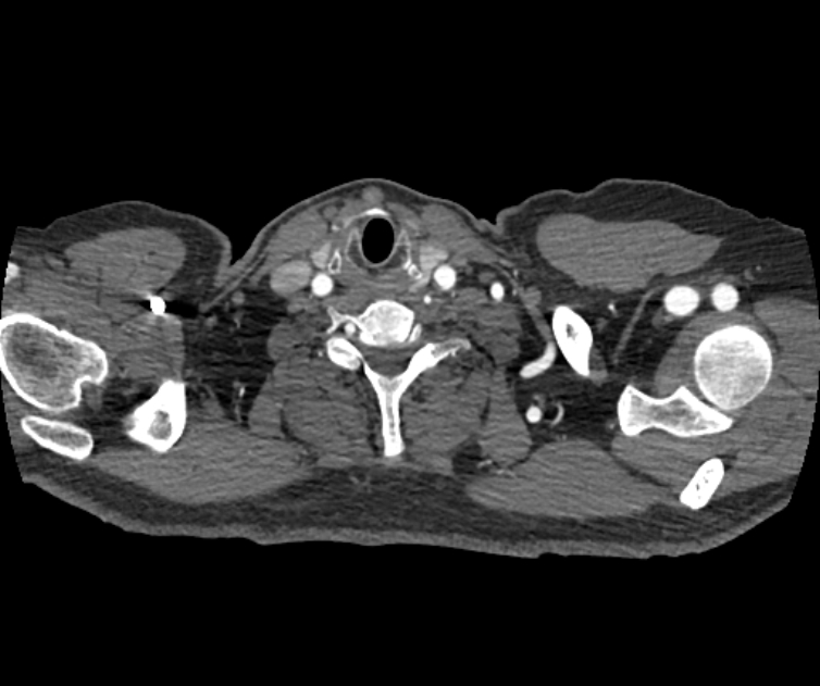 Coarctation of the aorta (Radiopaedia 53752-59822 A 8).jpg