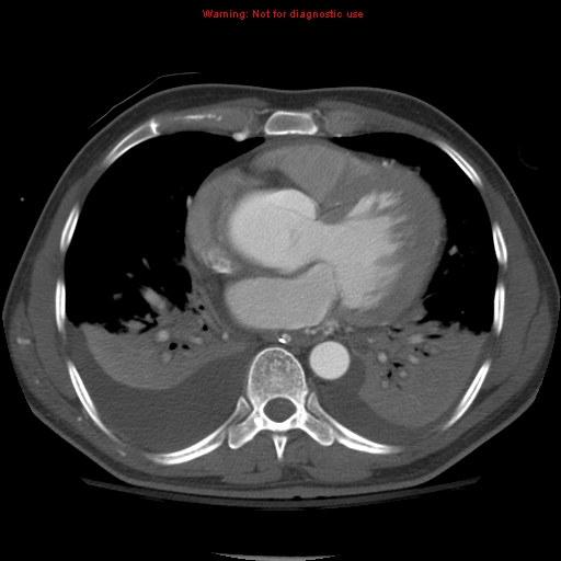 File:Coarctation of the aorta (Radiopaedia 8681-9490 B 40).jpg