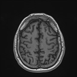 Cochlear incomplete partition type III associated with hypothalamic hamartoma (Radiopaedia 88756-105498 Axial T1 152).jpg