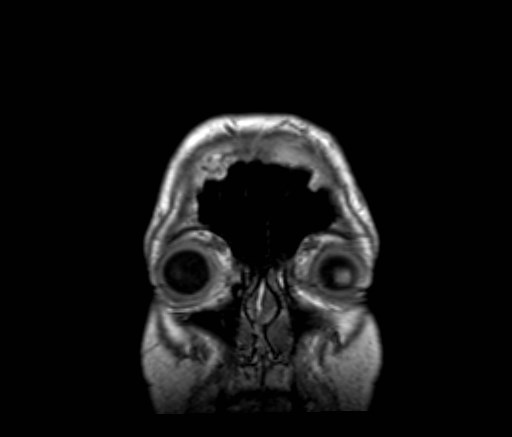 Cochlear incomplete partition type III associated with hypothalamic hamartoma (Radiopaedia 88756-105498 Coronal T1 61).jpg