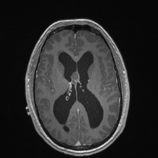 File:Colloid cyst (Radiopaedia 44510-48181 Axial T1 C+ 103).png