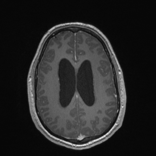 File:Colloid cyst (Radiopaedia 44510-48181 Axial T1 C+ 126).png