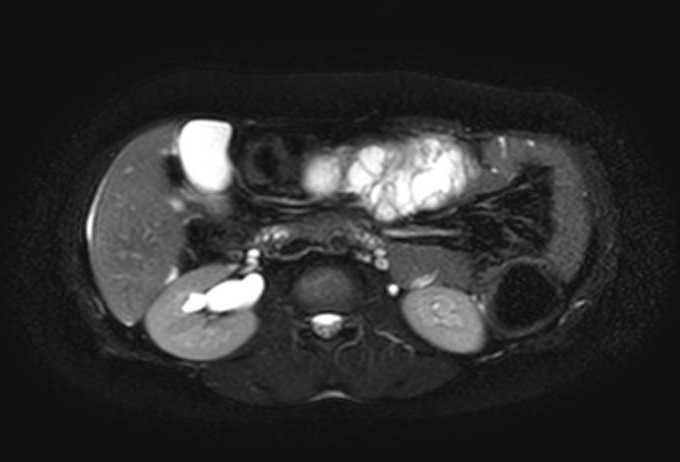 File:Colon adenocarcinoma with Krukenberg tumors, advanced pregnancy (Radiopaedia 67279-76645 Axial T2 SPAIR 49).jpg