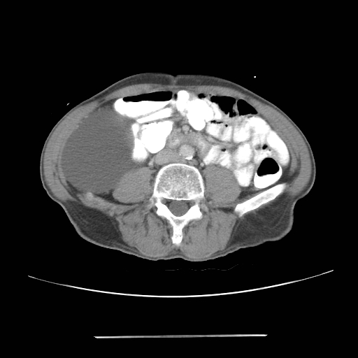 File:Colon cancer with calcified liver metastasis (Radiopaedia 74423-85307 A 44).jpg