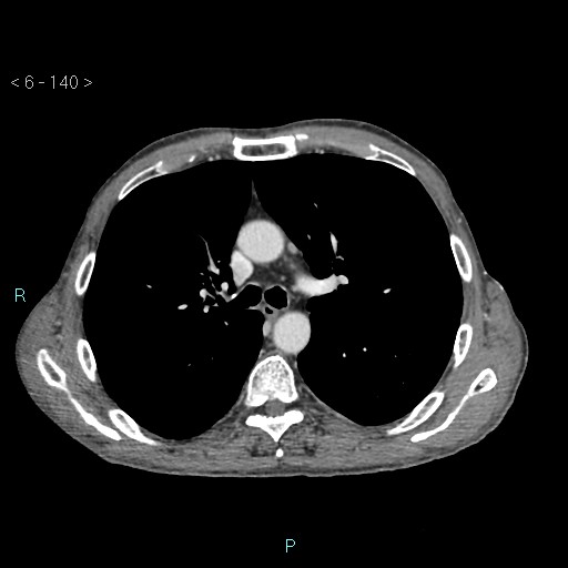 Colonic cancer (ultrasound and TC imaging) (Radiopaedia 50346-55713 B 140).jpg