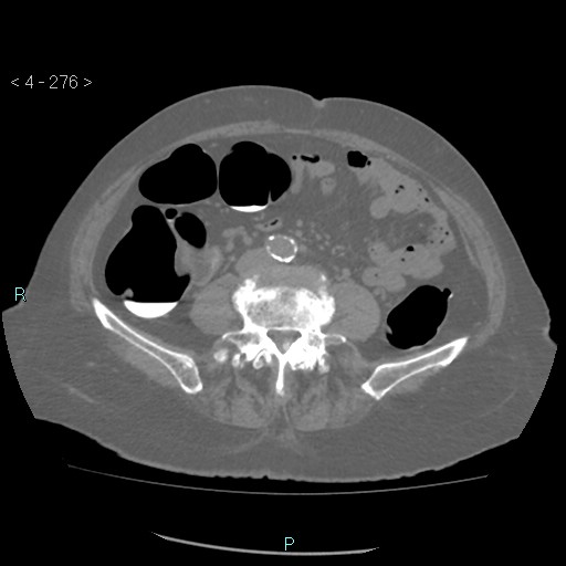 Colonic lipomas (Radiopaedia 49137-54244 Axial bone window 124).jpg