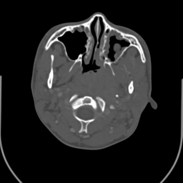 Nasopharyngeal carcinoma with skull base invasion (Radiopaedia 53415-59705 Axial bone window 55).jpg
