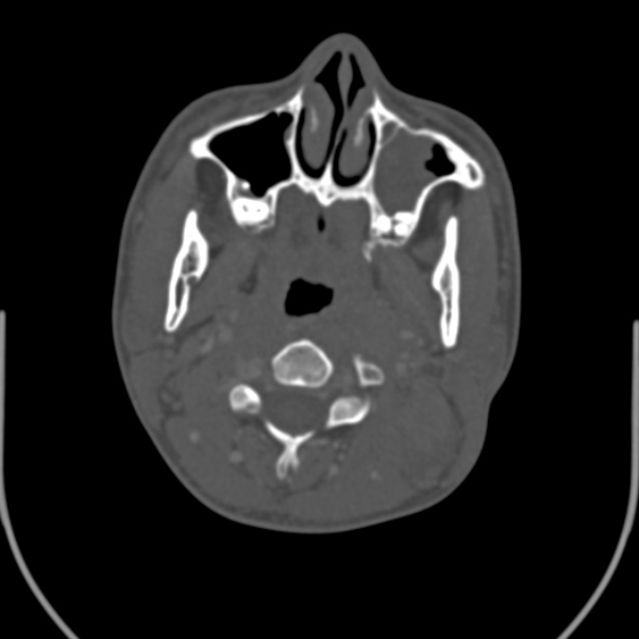 Nasopharyngeal carcinoma with skull base invasion (Radiopaedia 53415-59705 Axial bone window 73).jpg