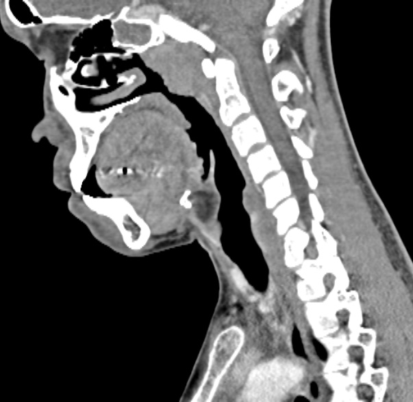 File:Nasopharyngeal carcinoma with skull base invasion (Radiopaedia 53415-59705 C 34).jpg