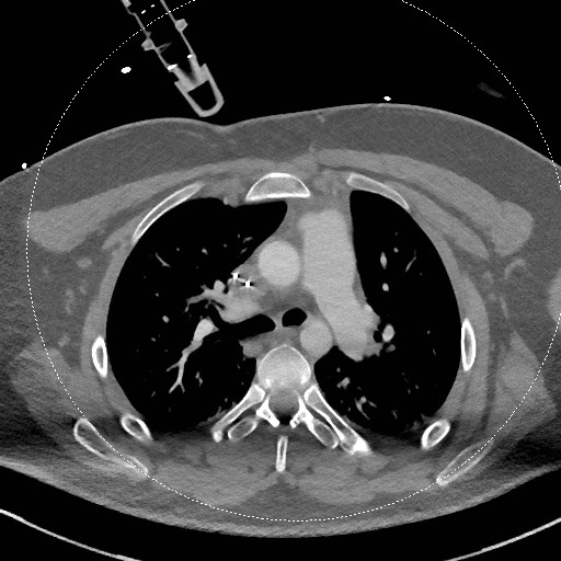 File:Neck CT angiogram (intraosseous vascular access) (Radiopaedia 55481-61945 B 37).jpg