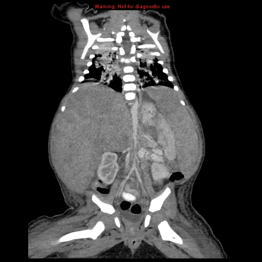 File:Neonatal neuroblastoma (Radiopaedia 9564-10223 B 84).jpg