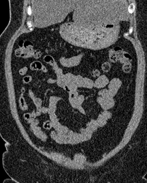 File:Nephrostomy for urosepsis (Radiopaedia 26180-26330 non-contrast 24).jpg