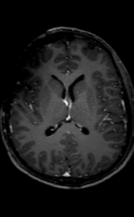 Neuro-Behçet disease (Radiopaedia 90112-107294 Axial T1 C+ 119).jpg