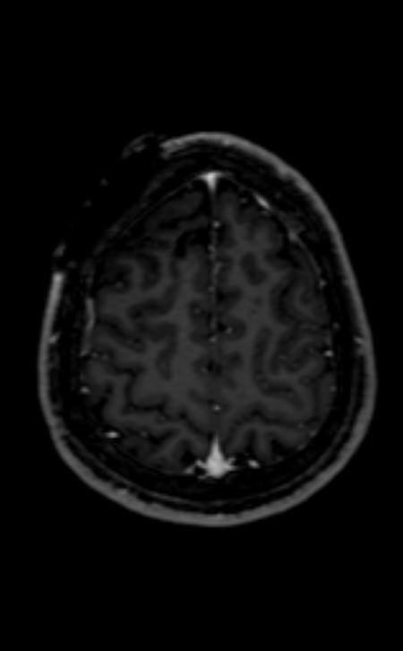 Neuro-Behçet disease (Radiopaedia 90112-107294 Axial T1 C+ 73).jpg