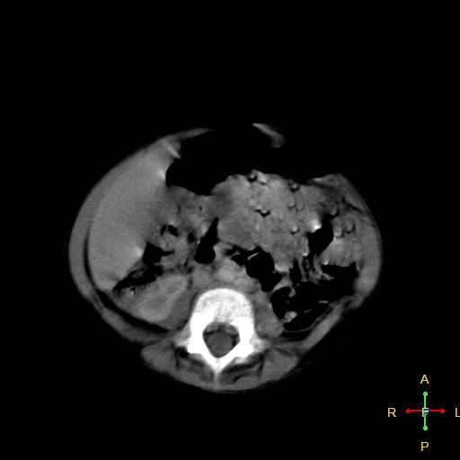 File:Neuroblastoma (Radiopaedia 24751-25016 D 26).jpg