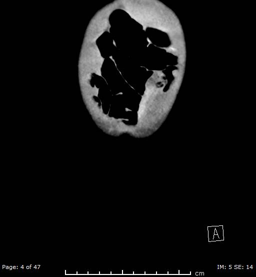 File:Neuroblastoma (Radiopaedia 41472-44355 B 4).jpg