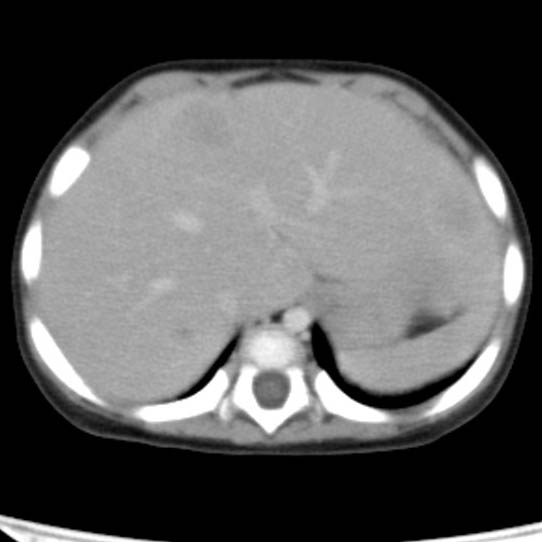 Neuroblastoma with skull metastases (Radiopaedia 30326-30960 C 8).jpg
