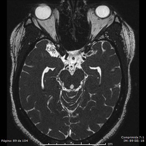 Neurocysticercosis (Radiopaedia 58636-65832 I 89).jpg