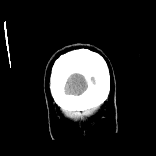Neurocysticercosis - granular nodular (Radiopaedia 42786-45957 Coronal C+ 64).png