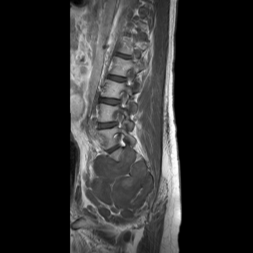 File:Neurofibromatosis type 1- extensive spinal involvement and Christmas tree sign (Radiopaedia 60610-68332 Sagittal T1 C+ 10).jpg