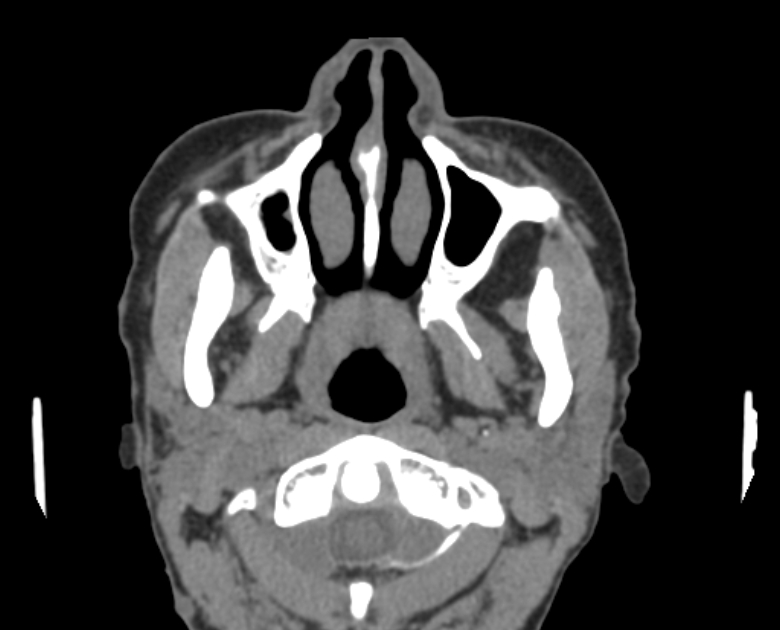 Neurofibromatosis type 1- orbital manifestations (Radiopaedia 49391-54511 Axial non-contrast 16).jpg