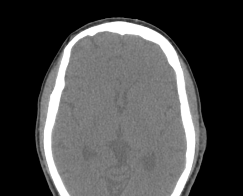 Neurofibromatosis type 1- orbital manifestations (Radiopaedia 49391-54511 Axial non-contrast 77).jpg