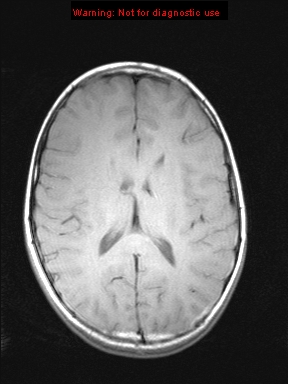 File:Neurofibromatosis type 1 with optic nerve glioma (Radiopaedia 16288-15965 Axial T1 10).jpg