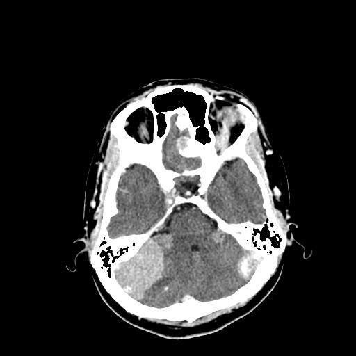 File:Neurofibromatosis type 2 (Radiopaedia 25389-25637 Axial C+ 21).jpg