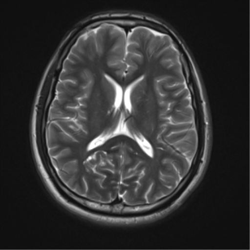 File:Neurofibromatosis type 2 (Radiopaedia 44936-48838 Axial T2 14).png