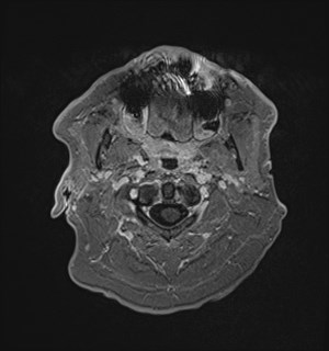 Neurofibromatosis type 2 (Radiopaedia 79097-92049 Axial T1 C+ 14).jpg