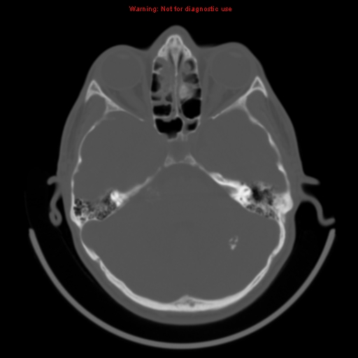 File:Neurofibromatosis type 2 (Radiopaedia 8953-9732 Axial bone window 10).jpg