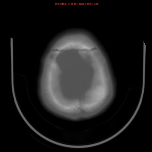 File:Neurofibromatosis type 2 (Radiopaedia 8953-9732 Axial bone window 29).jpg