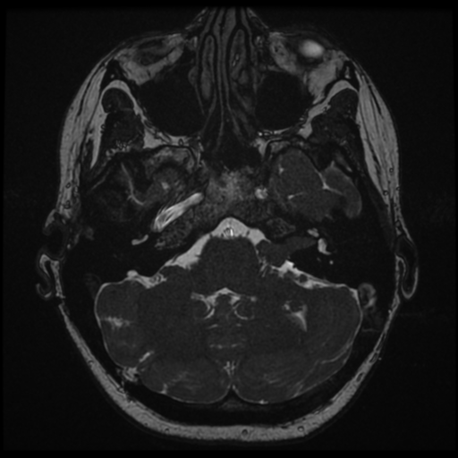 Neurofibromatosis type 2 - bilateral acoustic neuromata (Radiopaedia 40060-42566 Axial FIESTA 31).png