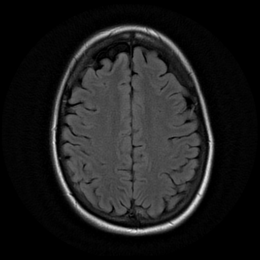 File:Neurofibromatosis type 2 - bilateral acoustic neuromata (Radiopaedia 40060-42566 Axial FLAIR 16).png