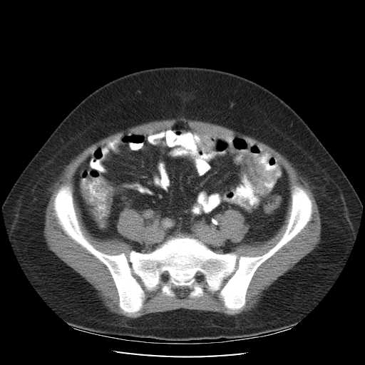 File:Non-Hodgkin lymphoma involving pelvis (Radiopaedia 21281-21197 B 46).jpg