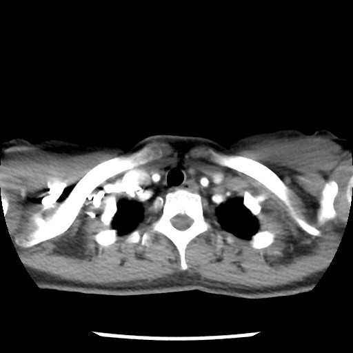 File:Non-small cell lung cancer with miliary metastases (Radiopaedia 23995-24193 A 7).jpg