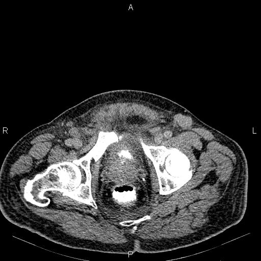 Non Hodgkin lymphoma in a patient with ankylosing spondylitis (Radiopaedia 84323-99621 Axial C+ delayed 78).jpg