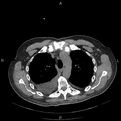 File:Non Hodgkin lymphoma in a patient with ankylosing spondylitis (Radiopaedia 84323-99624 Axial non-contrast 12).jpg